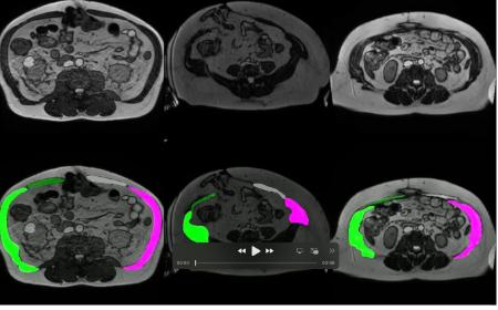 The network aims to leverage the recent advances in AI to accelerate and advance the study of the abdominal wall with the aim of identifying risk factors for hernia recurrence and ultimately reducing the recurrence rate. 